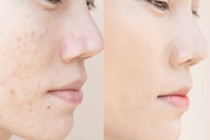 IPL Photofacial Treatment Benefits Near Lancaster County, Pennsylvania