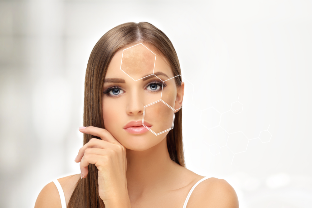 IPL Photofacial Treatment for Sun Damage in York, Pennsylvania