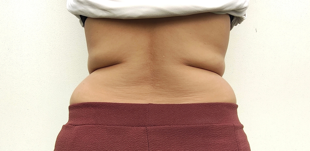 PCDC Fat Dissolving Injections