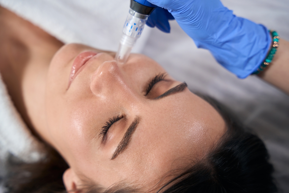 Microneedling for Fine Lines in Elizabethtown, Pennsylvania