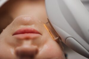 IPL Skin Rejuvenation in Leola, Pennsylvania for Redness and Rosacea