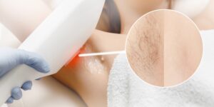 Tired of Shaving? Try Laser Hair Removal in Lancaster, Pennsylvania  