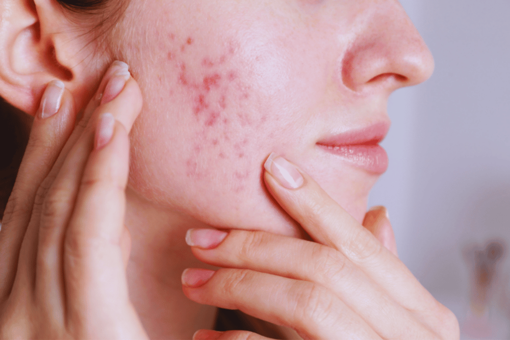 Laser Skin Resurfacing Near Gap PA
